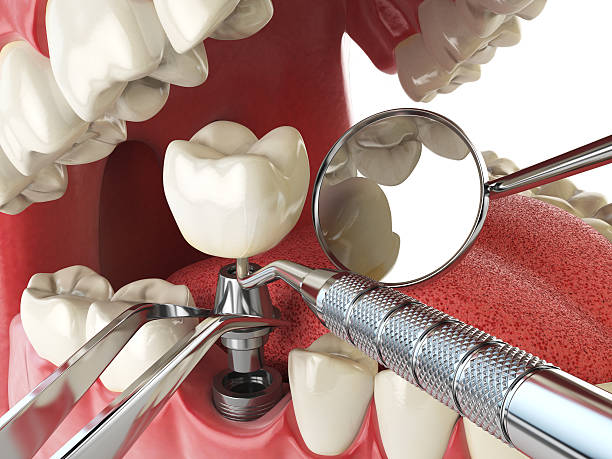 Best Emergency Wisdom Tooth Extraction in Rossford, OH